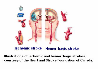 StroKe risk higher after shingles, but antiviral drugs may provide protection