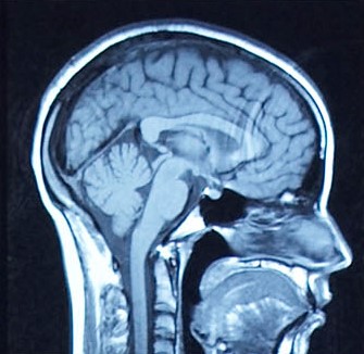 Brain scan