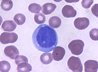 a leukemia cell