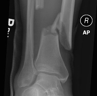 x-ray of a broken bone